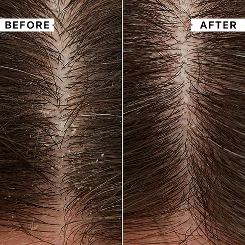 Image 1, before and after. image 2, key benefits. antimicrobial formula. tackles root cause of dandruff. refreshes, soothes and comforts. water based and fragrance free. image 3, 86% reported scalp felt soothed after use. 85% reported scalp felt less irritated after use. 79% reported flakes were reduced after use. image 4, key ingredients. camphor - cools and soothes. prioctone olamine - antimicrobial to relieve flaking and itching. benzalkonium chloride - for long lasting itch relief. image 5, i have used this for some years and couldn't be without it. it is calming and soothing and reduces the crazy itch that plagues my scalp. - customer review. image 6, before and after.