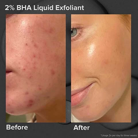 Image 1, 2% BHA liquid exfoliant before and after. Image 2, the iconic 2% bha liquid exfoliant, the gentle leave on formula that brings out skins natural glow. salicylic acid - concentrated bha penetrates deep into pores to clear breakouts sooner. gren tea quickly calms redness and soothes sensitivity. Image 3, the results 91% saw noticeably healthier skin. 90% saw improved texture. 82% saw smaller pores. based on consumer self assessment.