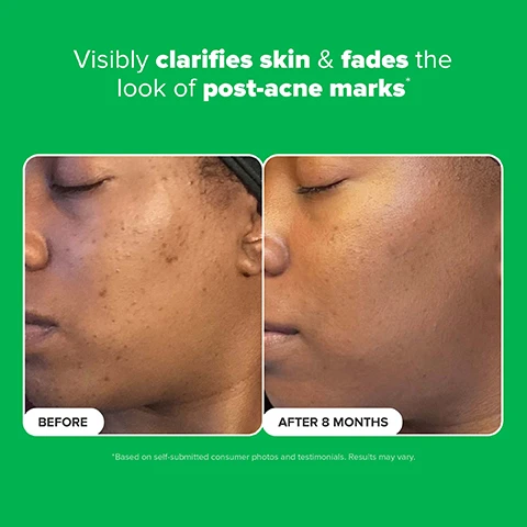 Image 2 - Image shows a side-by-side comparison of a persons face before and after eight months of treatment, illustrating improvements in skin clarity and reduction of post-acne marks, with visible text reading BEFORE on the left and AFTER 8 MONTHS on the right, along with additional text stating Visibly clarifies skin & fades the look of post-acne marks.
Image 3 - Image shows two tubes of Paulas Choice 10% Azelaic Acid Booster on a green background, with visible text listing benefits: Fades dark spots, Fights breakouts, Brightens skin.
Image 4 - Side-by-side comparison of a persons face showing skin before and after using a product; the left shows redness and post-acne marks labeled BEFORE, and the right shows clearer skin labeled AFTER 4 DAYS with text stating visibly clarifies skin & fades the look of post-acne marks.
Image 5 - Image shows a white, creamy substance with captions detailing ingredients: Azelaic Acid helps fade dark spots and post-acne marks, Salicylic Acid gently unclogs pores for smooth texture, and Adenosine soothes and restores the skin, with the title Whats inside.
Image 6 - An image of a white tube of skincare product with a swirl of the cream beside it, featuring green text that reads Skin Concerns, with icons for Rosacea prone, Dark spots, Breakout-Prone, and Dullness, and the label on the tube stating 10% Azelaic Acid Booster with Licorice & Salicylic Acid, All Skin Types, 30 ml / 1 fl. oz.
Image 7 - Image showing a comparison of skin before and after treatment for redness; the top section labeled BEFORE displays redness on the cheek and lower section labeled AFTER 3 WEEKS shows clearer skin with reduced redness, with the text Visibly reduces redness* in the background.
Image 8 - A hand holding a tube of Paulas Choice 10% Azelaic Acid Booster is shown being squeezed onto the palm, with text on the left providing usage instructions and a tip at the bottom stating that the boosters complement each other for better results.
Image 9 - Image shows four skincare products from Paulas Choice, with a white tube labeled 10% Azelaic Acid Booster, a bottle labeled C15 Super Booster with 15% Vitamin C, a bottle labeled Pro-Collagen Multi-Peptide Booster with 6x Peptide Complex, and a bottle labeled 10% Niacinamide Booster, all on colorful backgrounds, with additional text indicating product benefits below each item: Evens Tone, Brighter, smoother, Smoothes & firms, Refines pores.