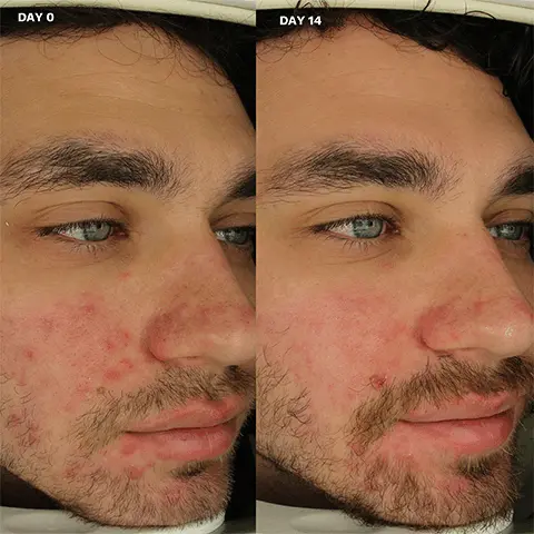 Image 1 - Day 0 vs Day 14.Image 2, Women and home Beauty Awards Winner 2022 Badge