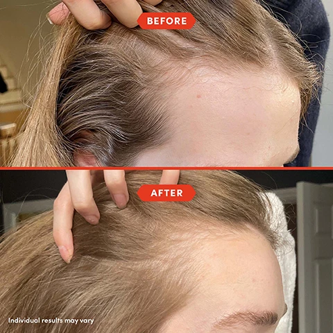 Image 1 - The image shows a side-by-side comparison of a persons hairline; the top section labeled Before displays a noticeable thinning hairline, while the bottom section labeled After shows a fuller appearance of hair, with a hand gently touching the hair; additional text at the bottom reads Individual results may vary.
Image 2 - A woman with long, straight hair poses holding a hair oil bottle, with text on a red background that reads Strengthens to help prevent breakage, Replenishes for increased hydration, Nourishes and balances the scalp, and for All Hair Types.
Image 3 - A hand holding a dropper above a bottle of hair serum against a bright orange background, with text stating 92% said their hair felt thicker, 92% said their scalp felt more nourished, 96% noticed less hair breakage from brushing, and additional information about a consumer survey of 25 participants after 2 weeks.
Image 4 - A bottle of Fable & Mane holistic hair oil is centrally placed on a light background, surrounded by bowls containing herbs and ingredients, with text labels highlighting Amla, Ashwagandha, and Holistic Plant Roots.
Image 5 - A close-up image of a dropper filled with hair oil against a soft, light-colored background, featuring text that reads a lightweight pre-wash scalp and hair oil for Stronger, Healthier looking Hair.