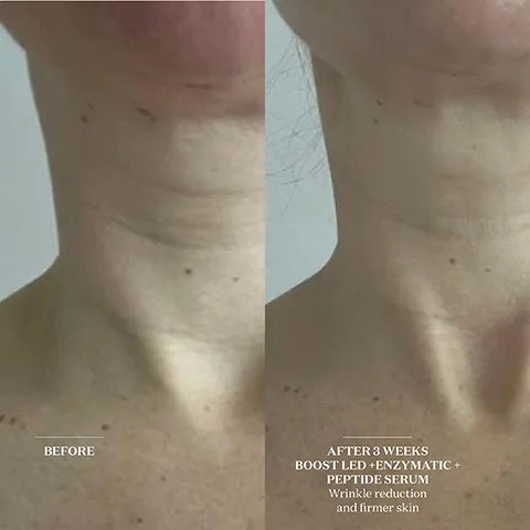 before and after 3 weeks boost LED, enzymatic and peptide serum. wrinkles reduction and firmer skin.