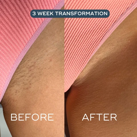 Image 1, before and after, 3 week transformation. image 2, multi tasking oil for ingrown hairs, razor rash, redness, bumps and more. for all skin, even intimate. image 3, after 2 weeks. 92% dry skin visibly improved, 85% reduced irritation caused by hair removal, 83% reduced redness, 81% reduced appearance bumps. clinical user trial, 102 women of all ages, stages and skin types. image 4, one oil to rule them all. this is incredible. been using on my pubic skin and underarms as i always get ingrowns and red bumps after shaving. after literally a few ueses and the tiniest amount needed as a little goes a long way. i have no redness and two ingrowns in my groin have disappeared don't hesitate. image 5, how to recycle - separate cap for pipette, rinse bottle and recycle cap, bottle and tube.