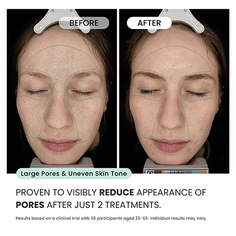 Image 1 - A side-by-side comparison image showing a womans face with closed eyes; the left side labeled BEFORE displays larger pores and uneven skin tone, while the right side labeled AFTER shows improved skin texture, with both images marked with green outlines over the areas of treatment, and text at the bottom stating PROVEN TO VISIBLY REDUCE APPEARANCE OF PORES AFTER JUST 2 TREATMENTS. Results based on a clinical trial with 30 participants aged 25-65. Individual results may vary.
Image 2 - Image shows a side-by-side comparison of a womans face before and after skin treatment, with red lines highlighting wrinkles and fine lines on the left (before) and green lines showing reduced wrinkles on the right (after); text reads: Fine Lines & Wrinkles, Proven to improve and soften appearance of wrinkles after 6 treatments. Results based on a clinical trial with 30 participants aged 25-65. Individual results may vary.
Image 3 - Image shows a side-by-side comparison of a persons face labeled Before on the left and After on the right, with red markings indicating dark spots and texture changes on the left and green markings on the right, along with the text Dark Spots & Texture and PROVEN TO VISIBLY IMPROVE OVERALL SKIN APPEARANCE BETWEEN 4 AND 12 WEEKS. Results based on a clinical trial with 30 participants aged 25–65. Individual results may vary.
Image 4 - Side-by-side comparison of a persons cheek before and after two treatments, showing clearer skin on the right; visible text includes BEFORE and AFTER 2 TREATMENTS.
Image 5 - A side-by-side comparison shows a womans face before and after six treatments, with the left image labeled BEFORE and the right image labeled AFTER 6 TREATMENTS.