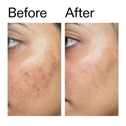 Image 1 - A close-up before and after comparison of skin showing significant improvement, with the left image labeled Before displaying acne and blemishes, and the right image labeled After showing clearer skin with reduced acne and faded spots. Image 2 - A close-up of a persons smiling face with a dollop of white cream on their cheek, next to text that reads: Clinically proven to hydrate and strengthen the skin barrier in 15 minutes* Visibly restores bounce in 3 days* *Clinical study of 31 people. Image 3 - Close-up of a smiling persons face with bright eyes, a gap in their front teeth, and glowing skin, alongside the text Why we love it, Strenghtens the skin barrier & boosts skins microbiome, Restores skins moisture barrier, Instantly softer, hydrated, smoother-feeling skin. Image 4 - The image displays text on a light gray background with a soft white blurred shape, outlining the products benefits: Why it works; 2% Ectoin DEEPLY HYDRATES AND STRENGTHENS THE BARRIER.; 2.5% Multi-Molecular Hyaluronic Acid HELPS DELIVER MULTI-LEVEL HYDRATION WITHIN THE SKIN’S SURFACE.; 1% Barrier Blend WITH 3 CERAMIDES TO HELP PROTECT THE SKIN’S BARRIER. Image 5 - A hand holds a small white drop of product on the fingertip against a white background, with text detailing instructions: How to use USE AM + PM. PEA SIZED AMOUNT. MASSAGE ONTO DAMP SKIN. AFTER CLEANSER, BEFORE MOISTURISER AND SPF IN THE AM. Image 6 - A white background with subtle grey wavy patterns displays a skincare routine guide with the text How to layer your routine and a numbered list: 1 CLEANSE, 2 HYDRATE, 3 TREAT, 4 MOISTURISE, 5 SPF, with the number 2 for HYDRATE circled.