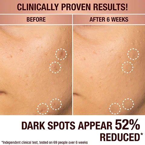 Image comparing skin before and after treatment, showing reduced dark spots; visible text includes CLINICALLY PROVEN RESULTS! BEFORE AFTER 6 WEEKS and DARK SPOTS APPEAR 52% REDUCED*