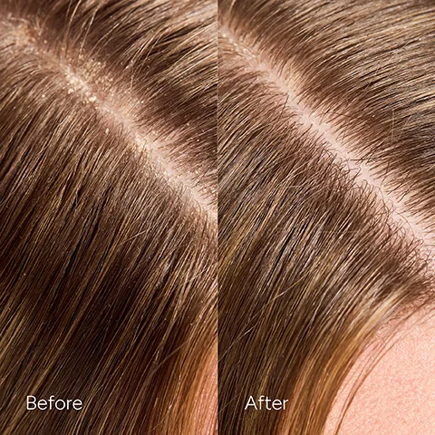 Image 5 - A split image of a scalp with brown hair showing visible dandruff along the hair part on the left labeled Before, and a clean scalp with no visible dandruff on the right labeled After.